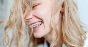 Что такое самолигирующие брекеты?