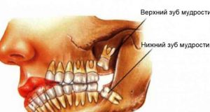 Чи потрібно видаляти зуби мудрості?