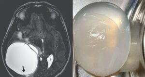 Індія: підліток захворів на ехінококоз. Лікарі видалили йому кісту мозку Індія: підліток захворів на ехінококоз. Лікарі видалили йому кісту мозку